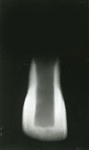 MOORREES classification system (1963): 1/2 root formation