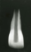 MOORREES classification system (1963): Full root formation with wide open apex