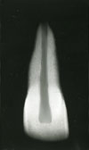 MOORREES classification system (1963): Full root formation with 1/2 closed apex