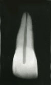 MOORREES classification system (1963): Full root formation with closed apex